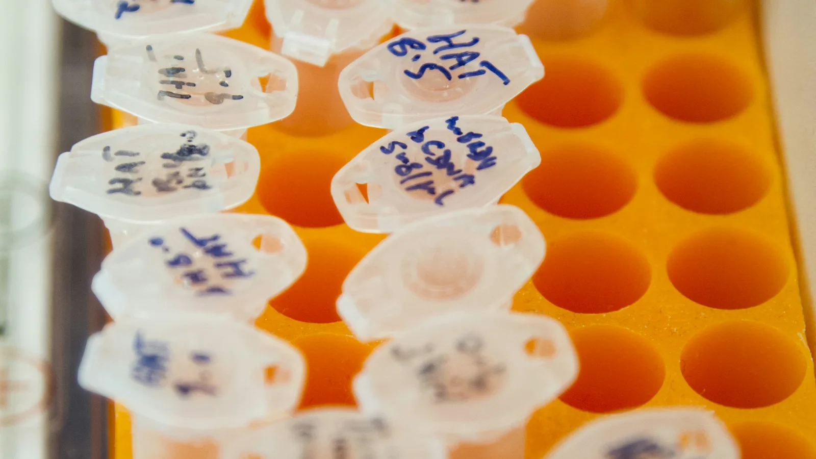 uACR and eGFR: Two Tests That Reveal Hidden Kidney and Cardiovascular Risk